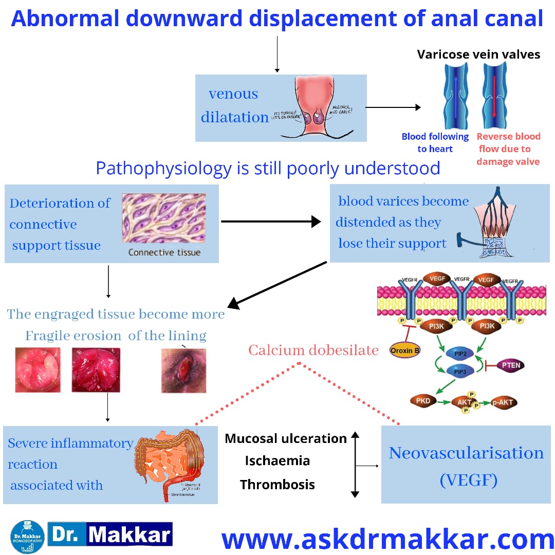 Pathophysiology Of Haemorrhoidal veins in Piles || बवासीर में रक्तस्रावी नसों का पैथोफिज़ियोलॉजी by homeopthic Dr Makkar